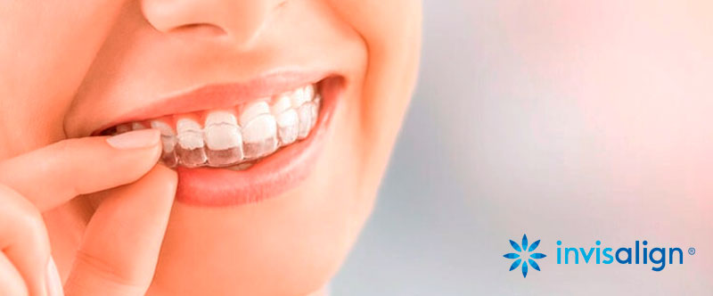 Tecnología Invisalign